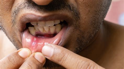 How Long Do Canker Sores Last ? - GoodRx