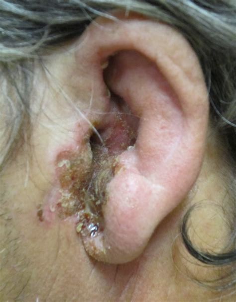 Otitis externa physical examination - wikidoc