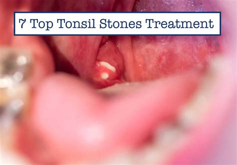 Tonsil Stones Texture at Ted Hayes blog