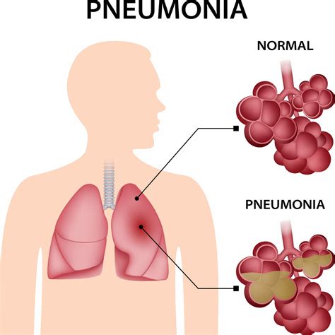 Pneumonia - Private Pneumonia Treatment - Respiratory London
