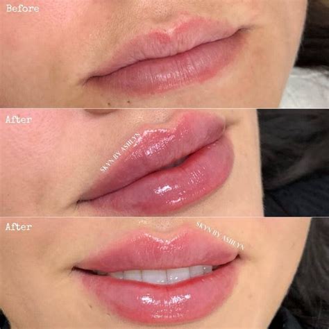How Long Does Swelling Last After Lip Filler? - Public Health