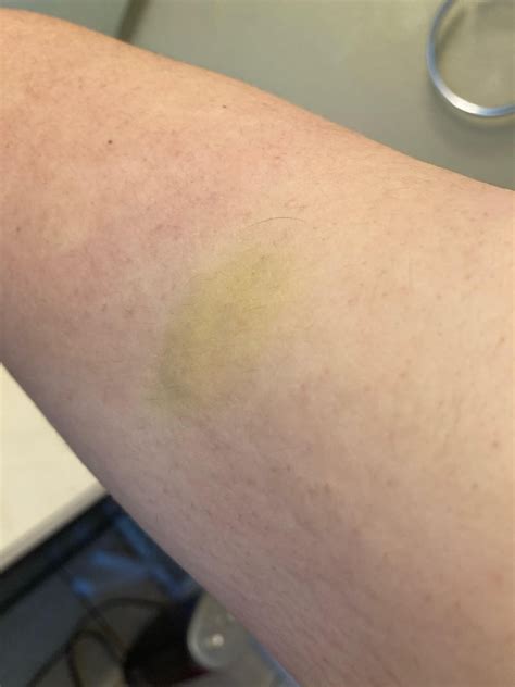 Yellow Spots On Skin Arms at Aileen Markham blog