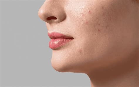 What Causes Fungal Acne? | The Derm Spot Guide to Clear Skin