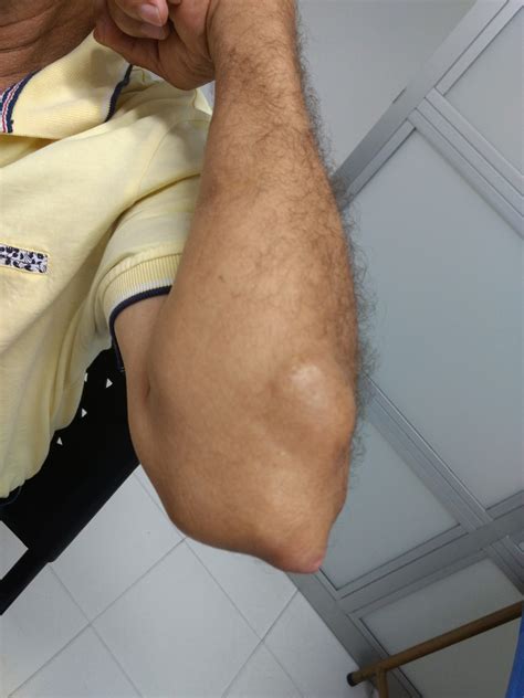 What Is Elbow Gout at Genevieve Tarrant blog