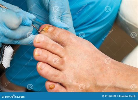 Doctor Treats an Ingrown Toenail with a Medical Instrument, Removal and Disinfection Stock Photo ...