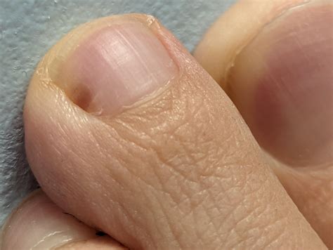Melanoma under nail or something else? : r/DermatologyQuestions