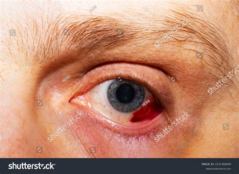 Hemorrhage Eye Rupture Vessel Eye Blood Stock Photo 2231266699 ...