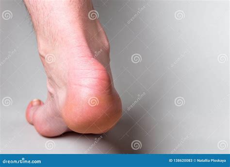 Bump On The Back Of Heel Bone Called Haglund`s Deformity On Gray Background. Stock Image ...