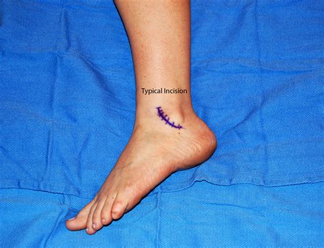 Lateral Ankle Ligament Reconstruction Torn Ligament In Ankle, Ankle Ligaments, Ankle Fracture ...