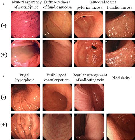 Erythematous Mucosa In The Stomach