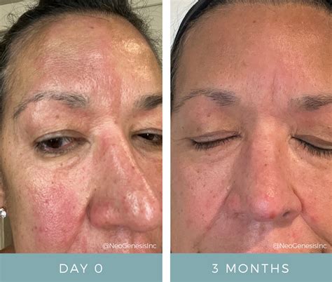 Before + After - Rosacea + Seborrheic Dermatitis - NeoGenesis