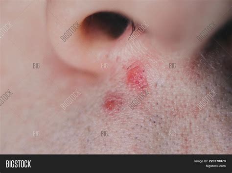Pimple Under Nose