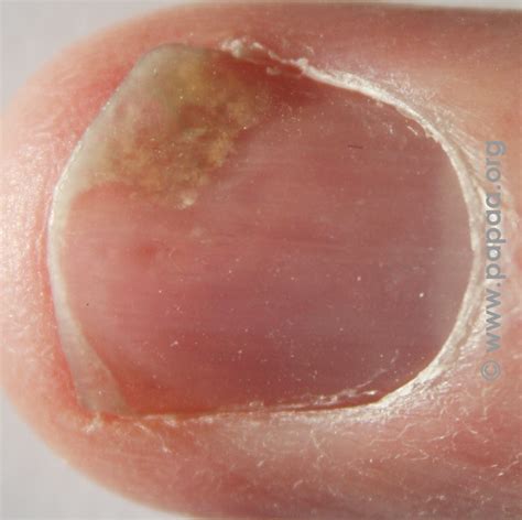 Pictures of psoriasis and psoriatic arthritis - PAPAA