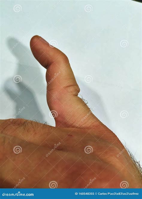 Dislocated Little Finger Joint before Treatment and Healing Stock Image ...