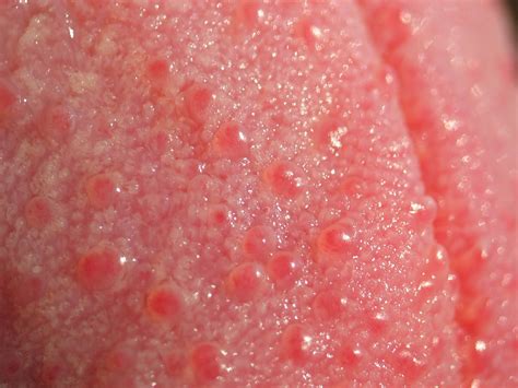 Bumps On Back Of Tongue And Throat