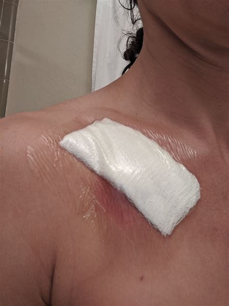 Port-a-Cath Insertion Surgery | a.steed's.life
