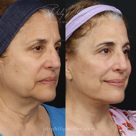 Deep Plane Facelift in New York - Philip Miller MD