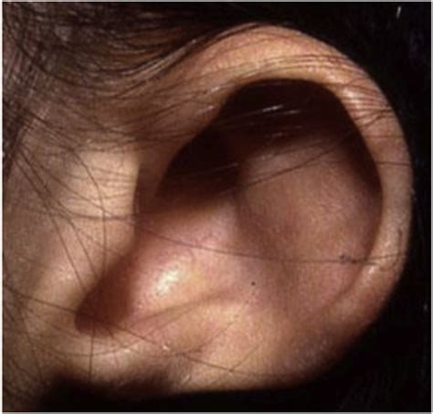 Early Intervention Across the Life Span for Patients With CHARGE ...