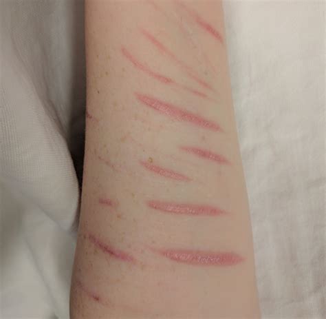 File:SelfHarm2017.jpg - 维基百科，自由的百科全书