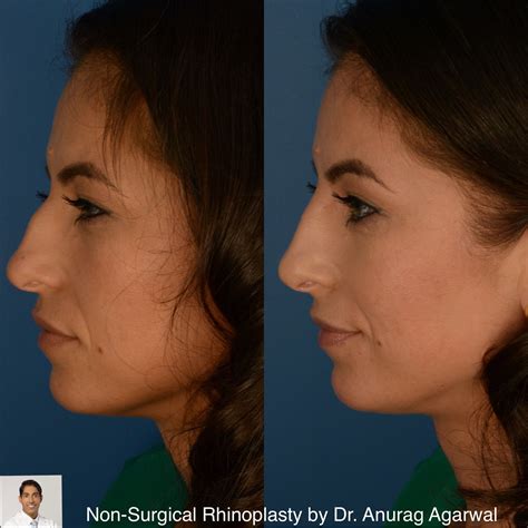 Non Surgical Nose Job Non Surgical Nose Job Miami | Liquid