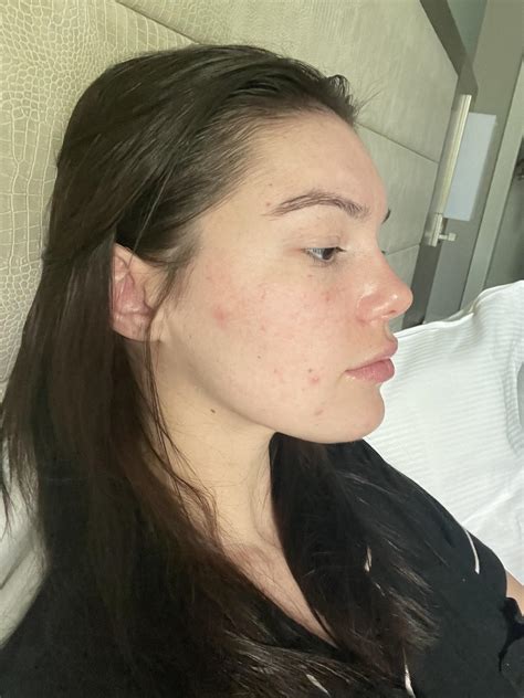 No matter what I do I have these breakouts : r/SkincareAddicts