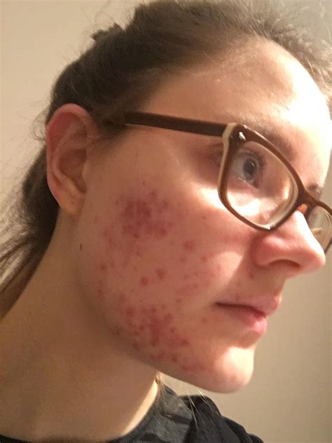 Ortho Tri Cyclen Lo Acne