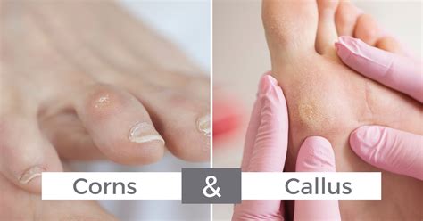 Understanding Corns and Calluses — Blackwood Podiatry | Your local podiatrist in Blackwood