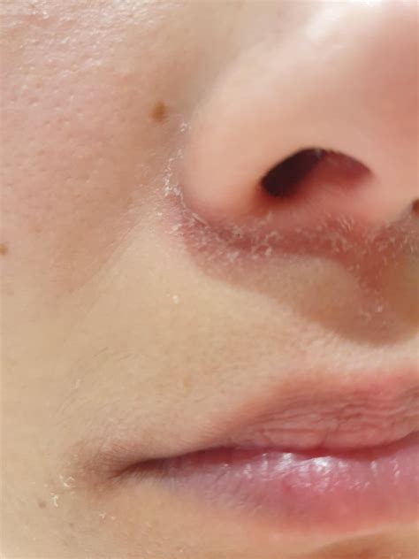 Itchy Scaly Rash Around Nose Skin Rashes & Conditions | Types & When
