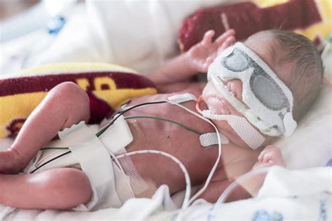 Premature Babies Born At 32 Weeks