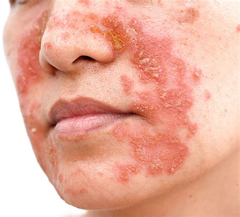 Petaloid Seborrheic Dermatitis