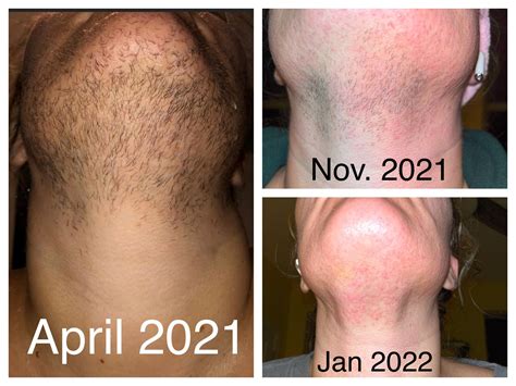 Pcos Facial Hair