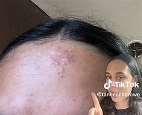 I got herpes on my face at a concert — and ended up in a hospital | New York Post