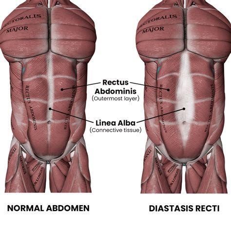 Rectus Abdominis Diastasis In Males