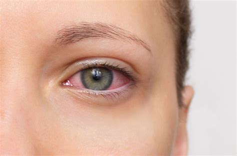 Can Dry Eyes Cause Blindness