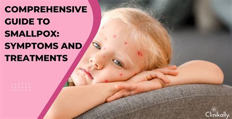 Comprehensive Guide to Smallpox: Symptoms and Treatments | Clinikally