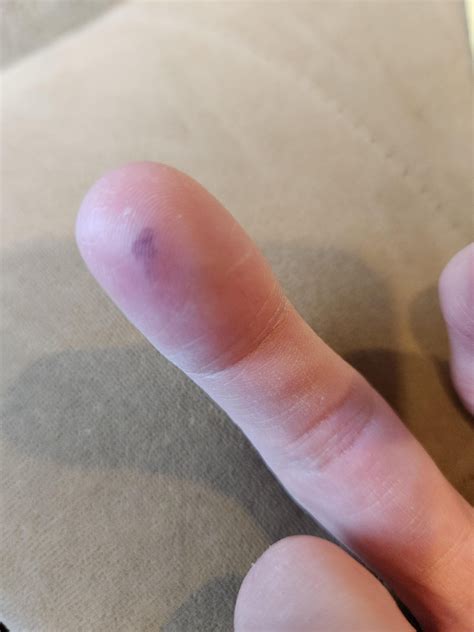 itchy fluid filled bump on finger, started as lump under skin, then bruise? now pain and itching ...