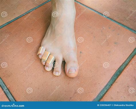 Unhealthy Toes With Toenails Affected By Fungal Disease Stock Photo ...