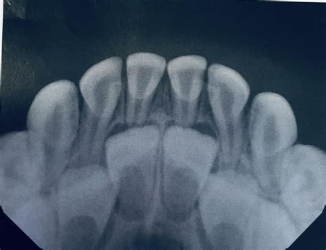 My 4yr old daughter's dental X-ray image : mildlyinteresting