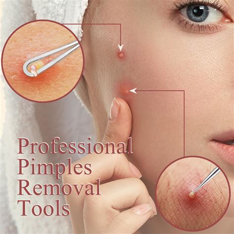 Blackhead Remover and Pimple Popper Tool Kit, Ingrown Hair Tweezers ...
