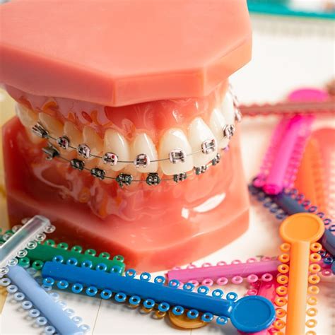 How Do Braces Work? Everything You Need To Know