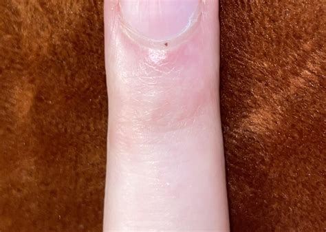 New “mole” appeared out of nowhere on my finger : r/DermatologyQuestions
