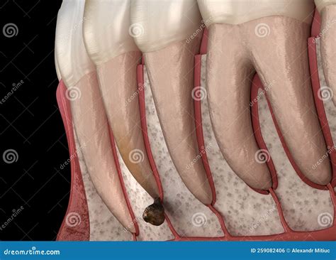 Periostitis Tooth - Lump on Gum Above Tooth. Medically Accurate Dental ...