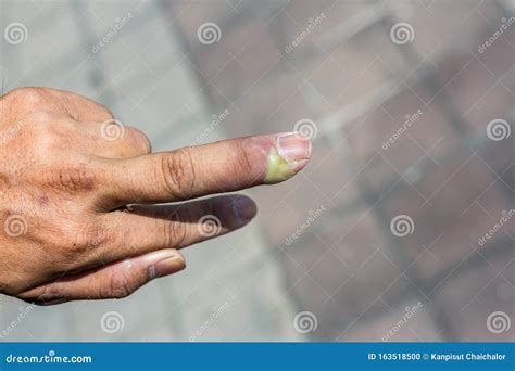 Infected Smashed Finger