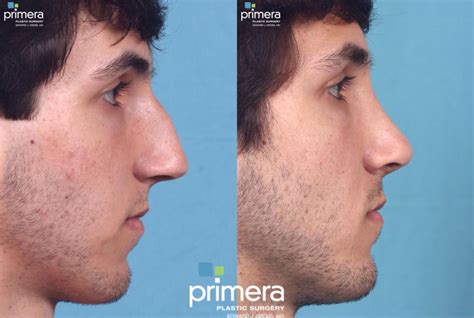 Nose Jobs for Men: What Sets Male Rhinoplasty Apart