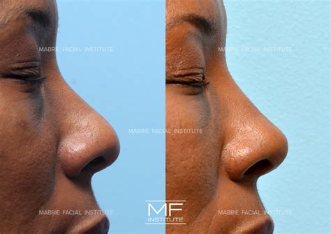 Your Top Non Surgical Nose Job Questions, Answered Mabrie Facial ...