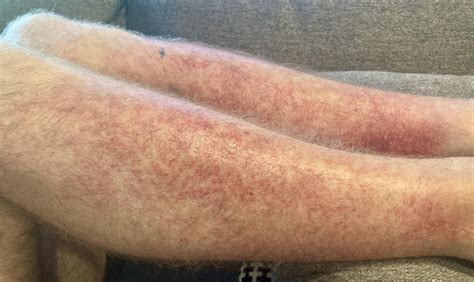 Itchy bilateral lower extremity rash : r/DermatologyQuestions