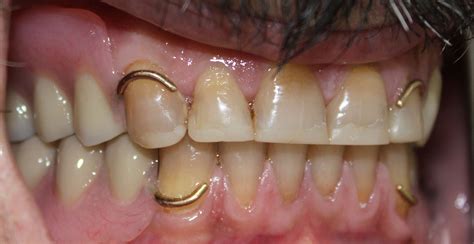 What Are Clip On Teeth at Janet Cantrell blog