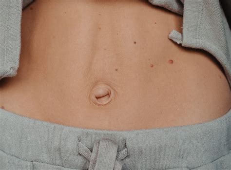 Umbilical Hernia In Women