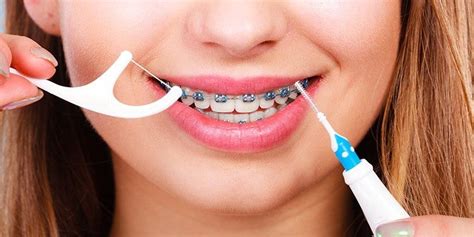 Braces Payment Plan: How to Pay for Braces |Smile Generation