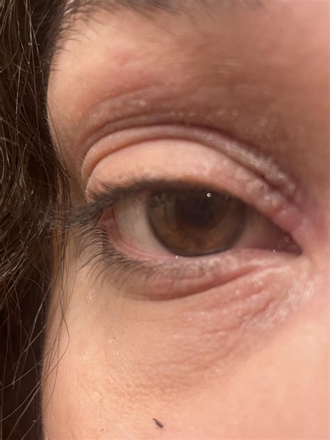 Eyelid eczema getting worse with the weather. Gets so dry the skin ...